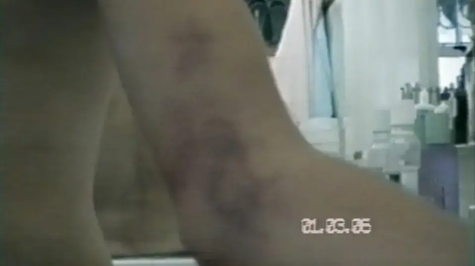 Mathew's mysterious bruises on his arm in "Lake Mungo".